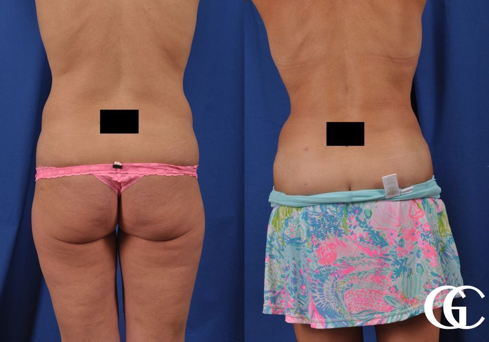 Abdominoplasty - Thumbnail 2