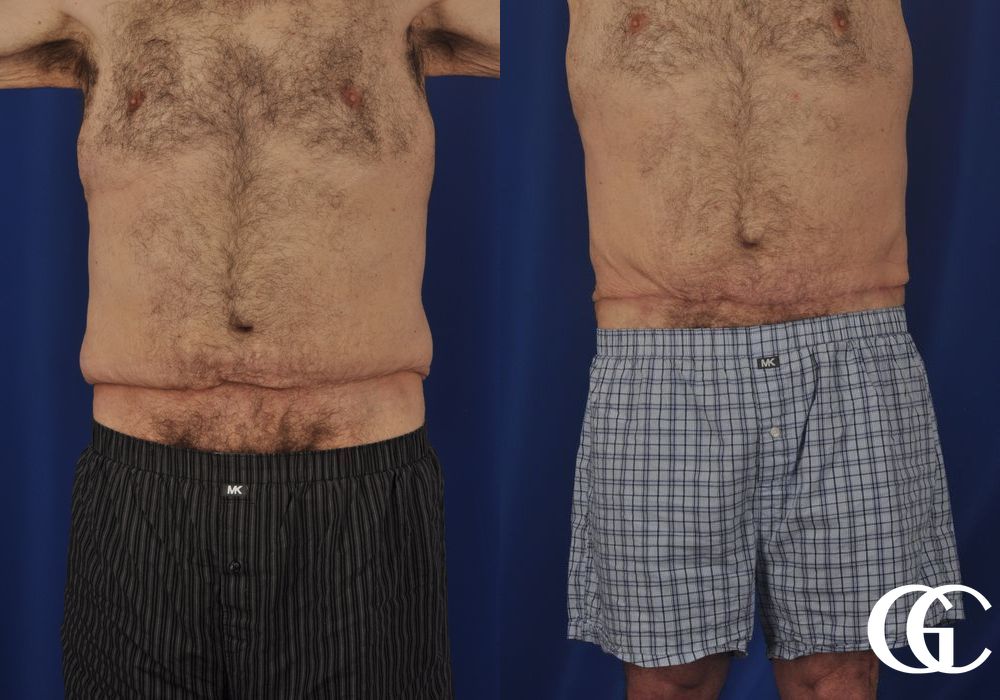 Abdominoplasty for Men - Case 7534