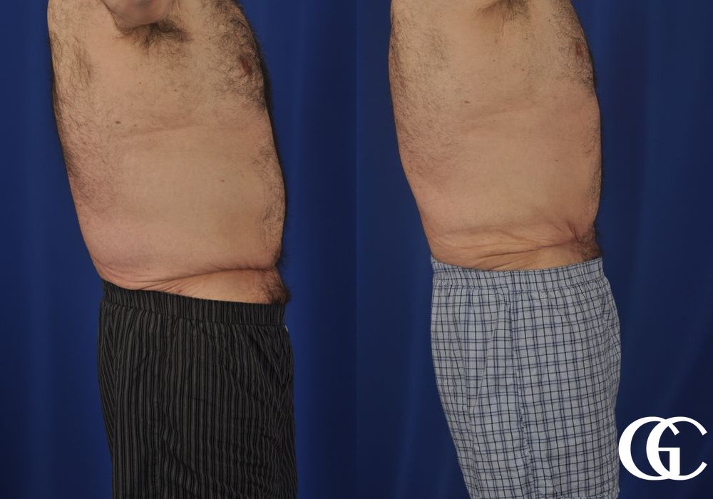 Abdominoplasty for Men - Thumbnail 4