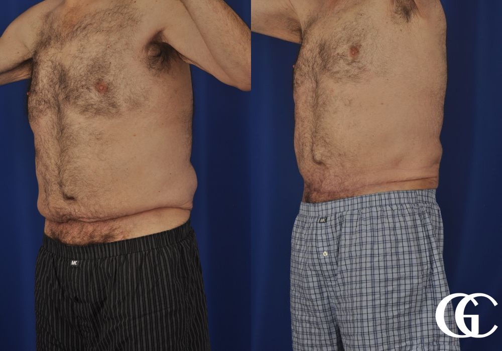 Abdominoplasty for Men - Thumbnail 5