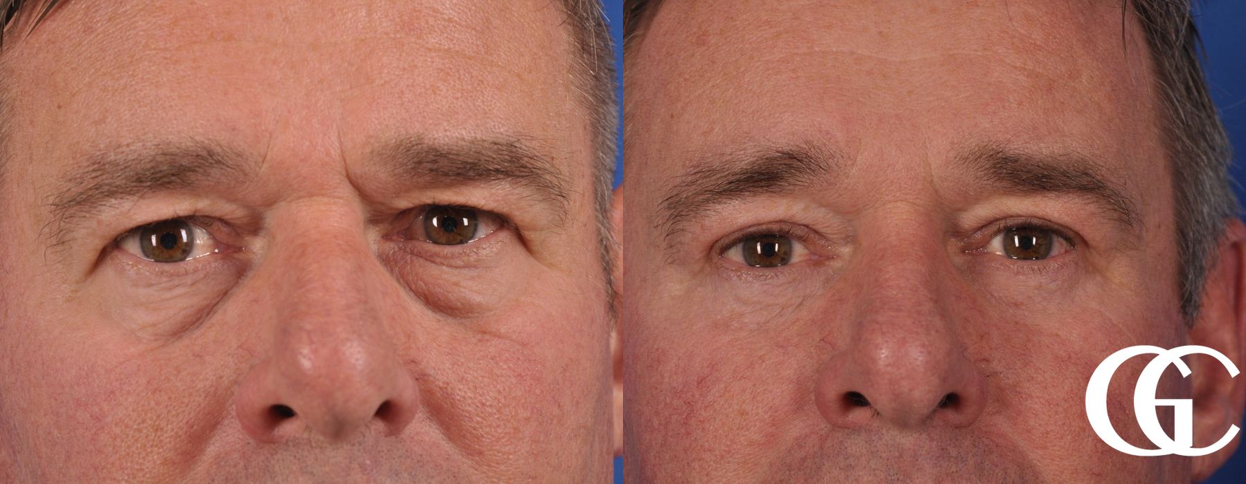 Blepharoplasty for Men - Case 7537
