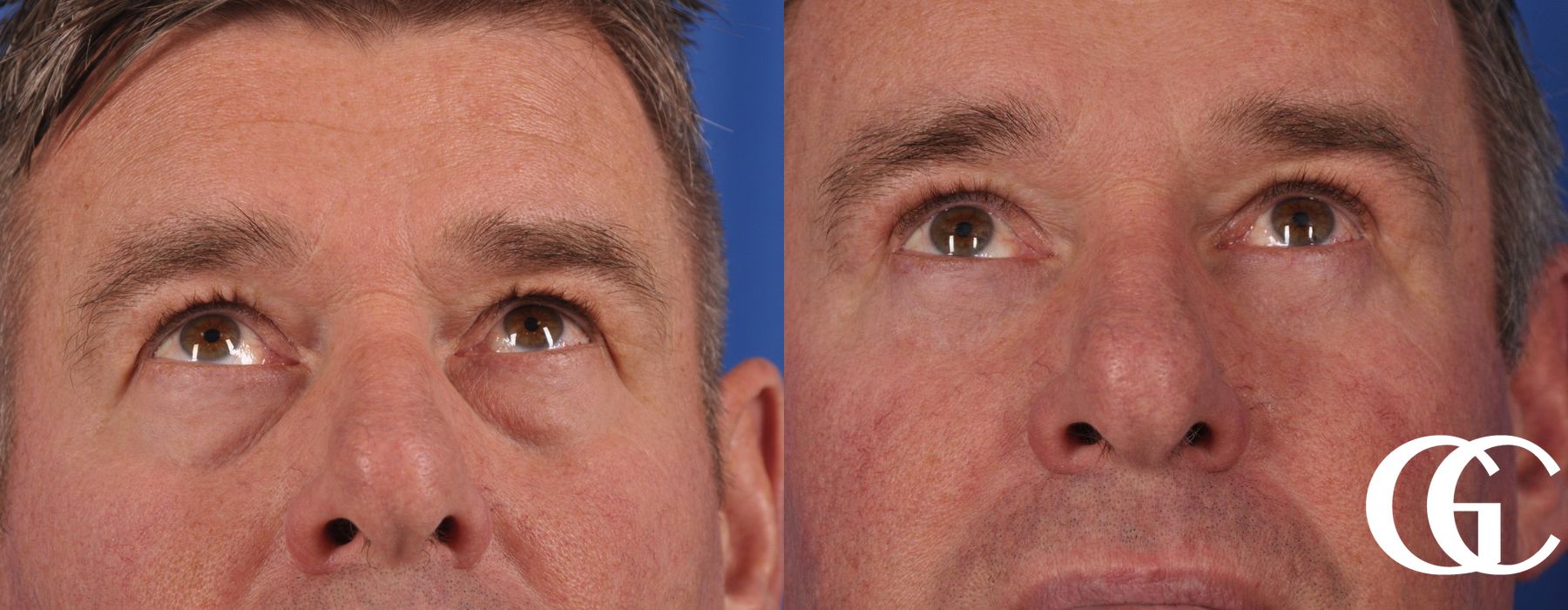 Blepharoplasty for Men - Thumbnail 3