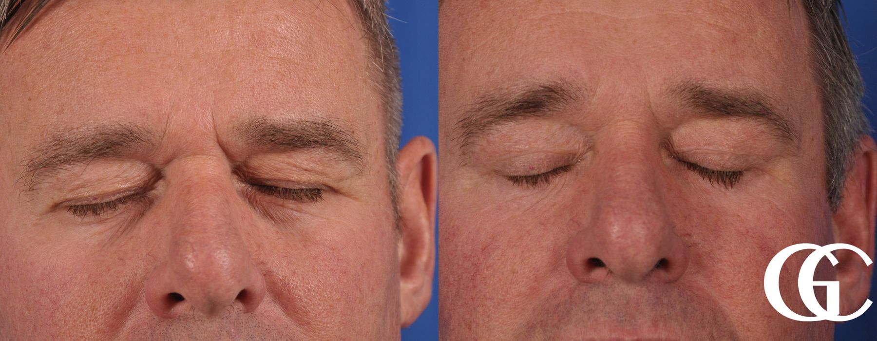 Blepharoplasty for Men - Thumbnail 2