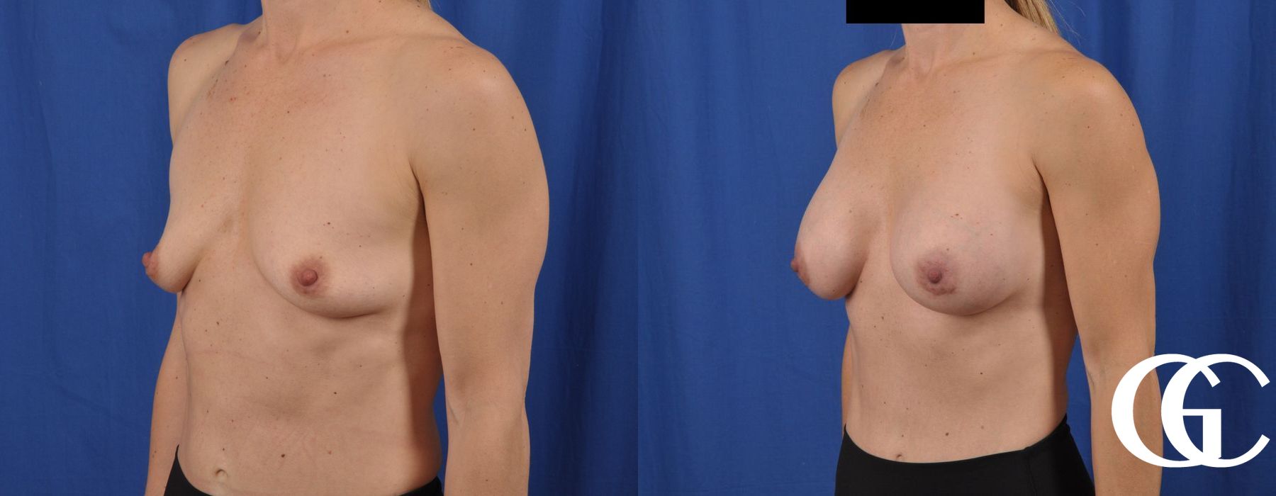 Breast Augmentation - Thumbnail 3