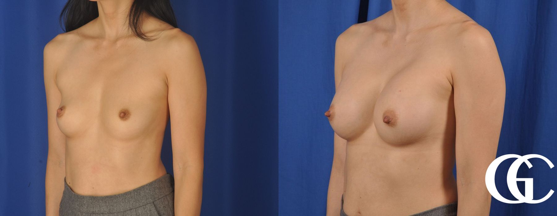 Breast Augmentation - Case 7212