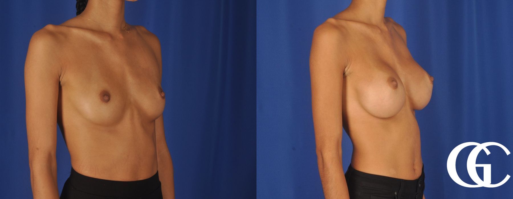 Breast Augmentation - Thumbnail 4