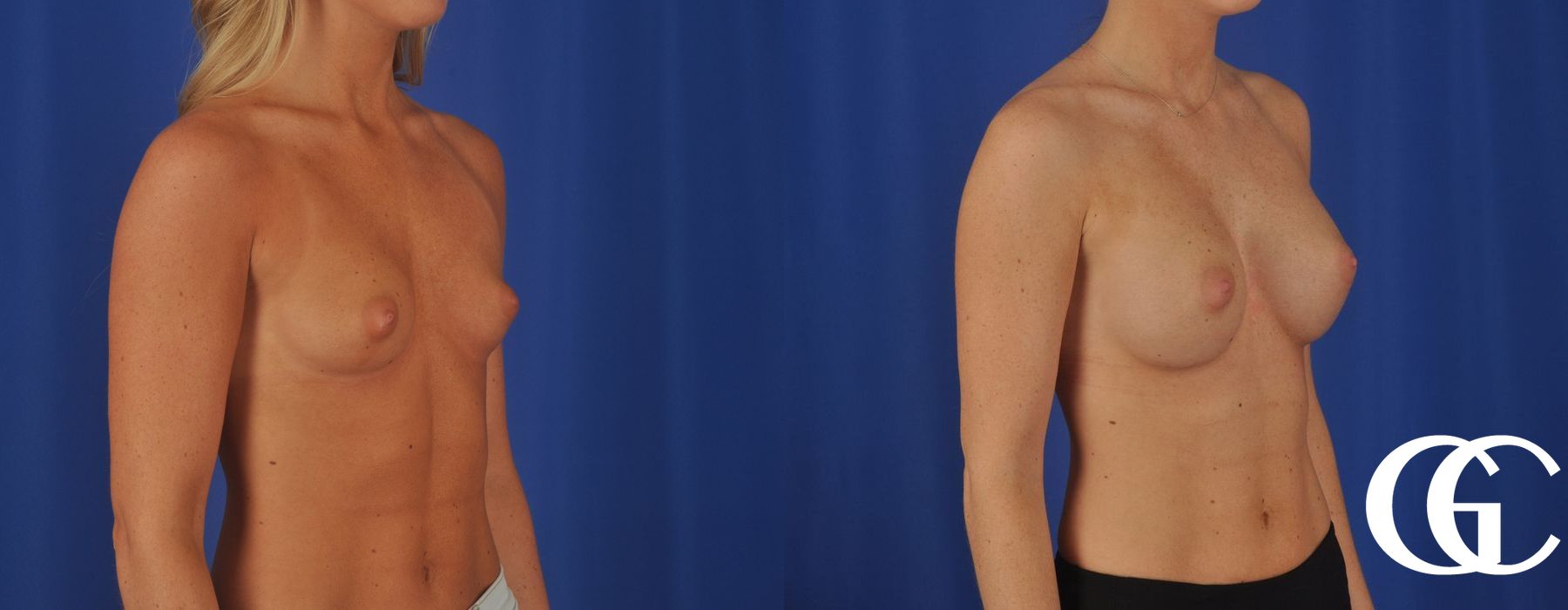 Breast Augmentation - Thumbnail 2