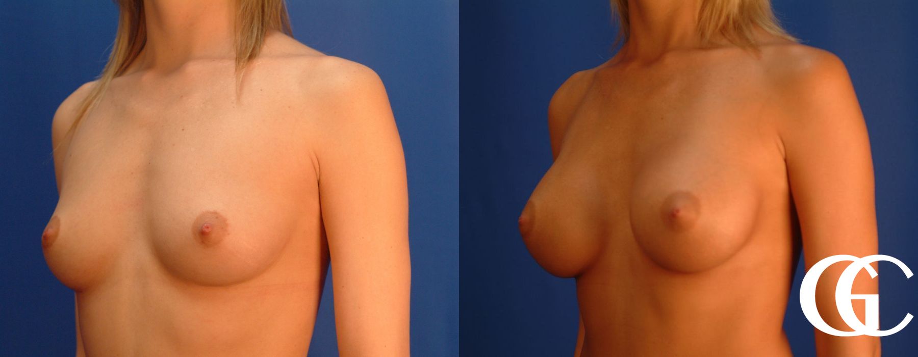 Breast Augmentation - Thumbnail 4