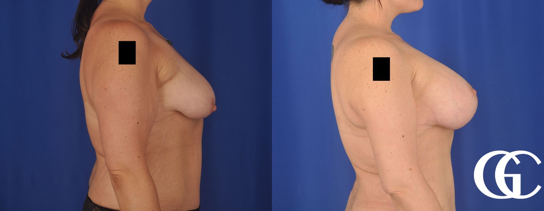 Breast Augmentation - Case 7197