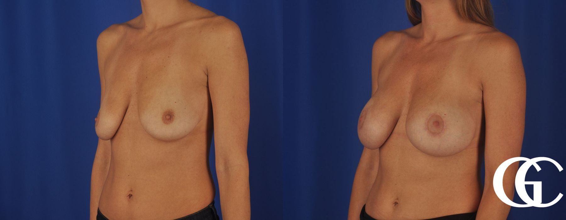Breast Augmentation - Thumbnail 4