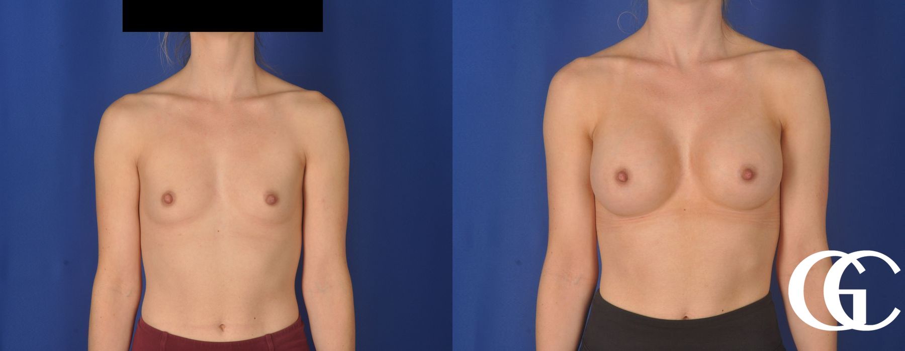 Breast Augmentation - Case 7163