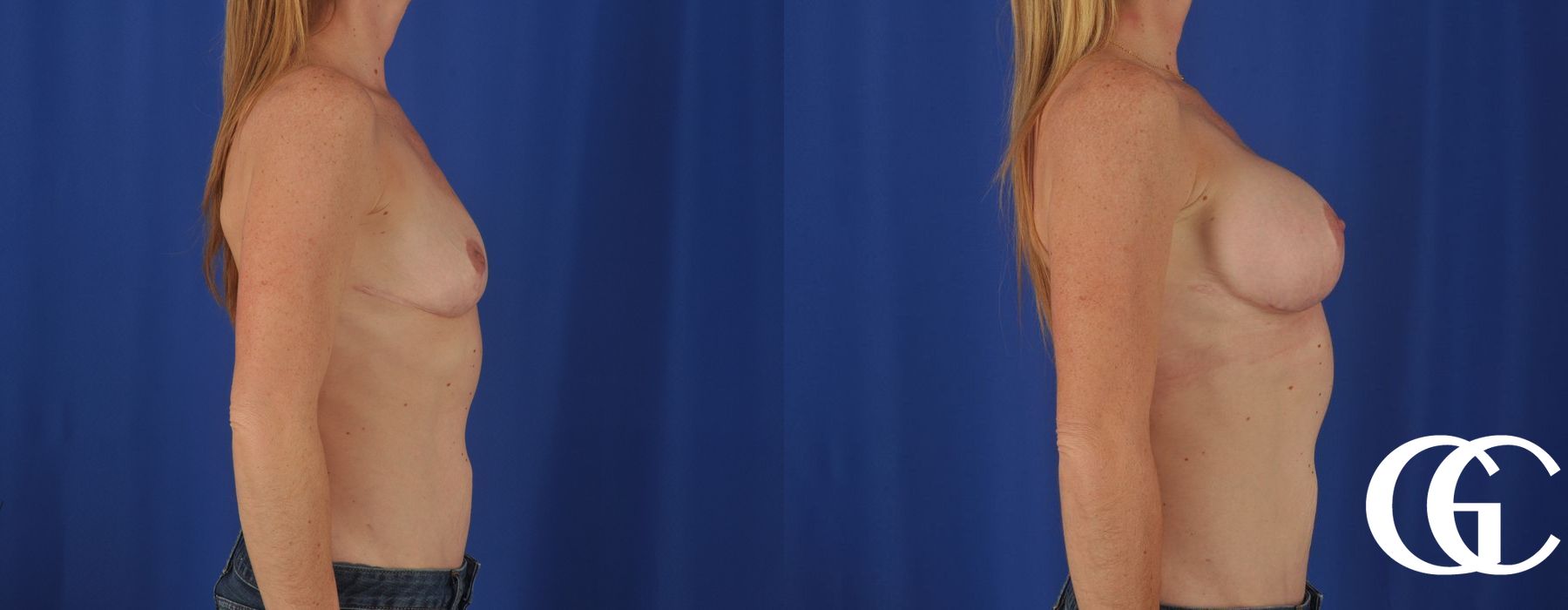 Breast Augmentation - Thumbnail 3