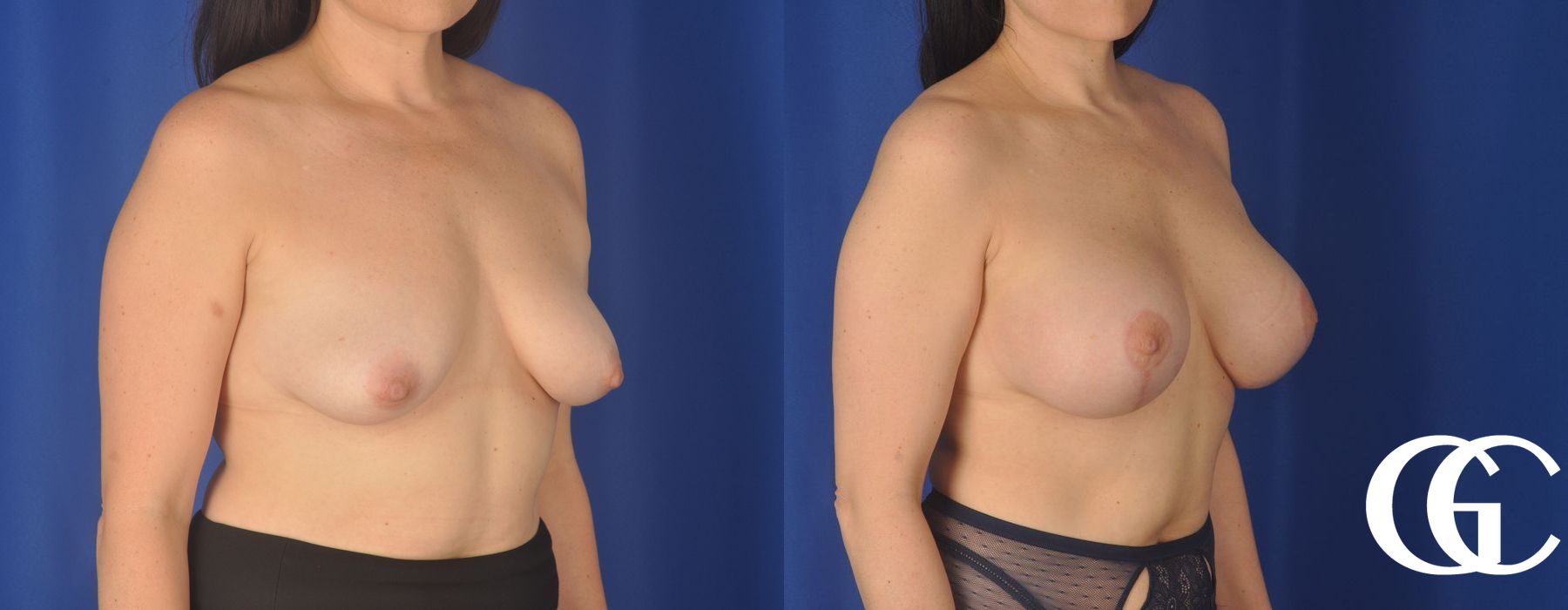 Breast Augmentation - Thumbnail 4