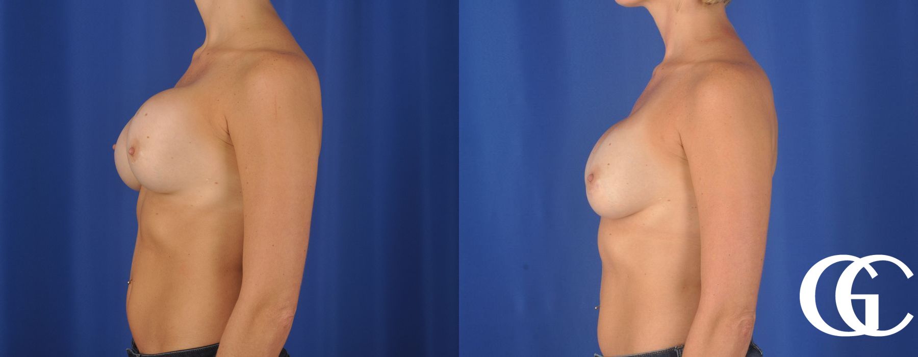 Breast Augmentation - Thumbnail 4