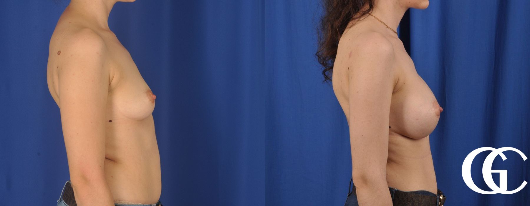 Breast Augmentation - Thumbnail 4