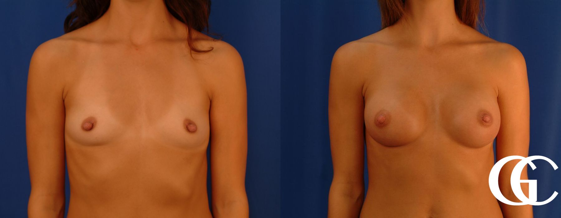 Breast Augmentation - Case 7076