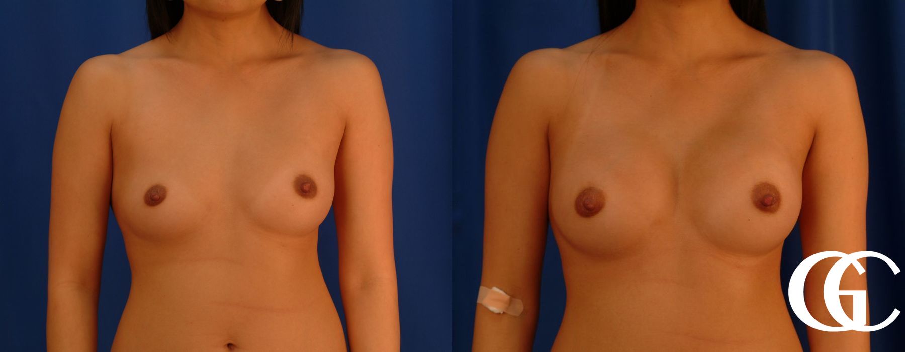 Breast Augmentation - Thumbnail 2