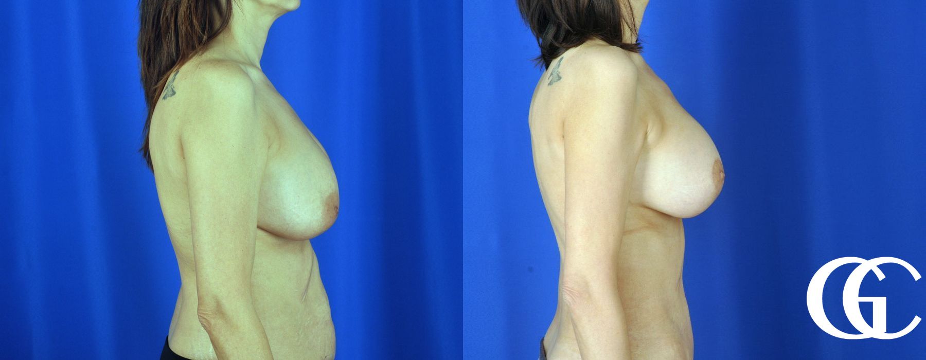 Breast Augmentation - Thumbnail 4