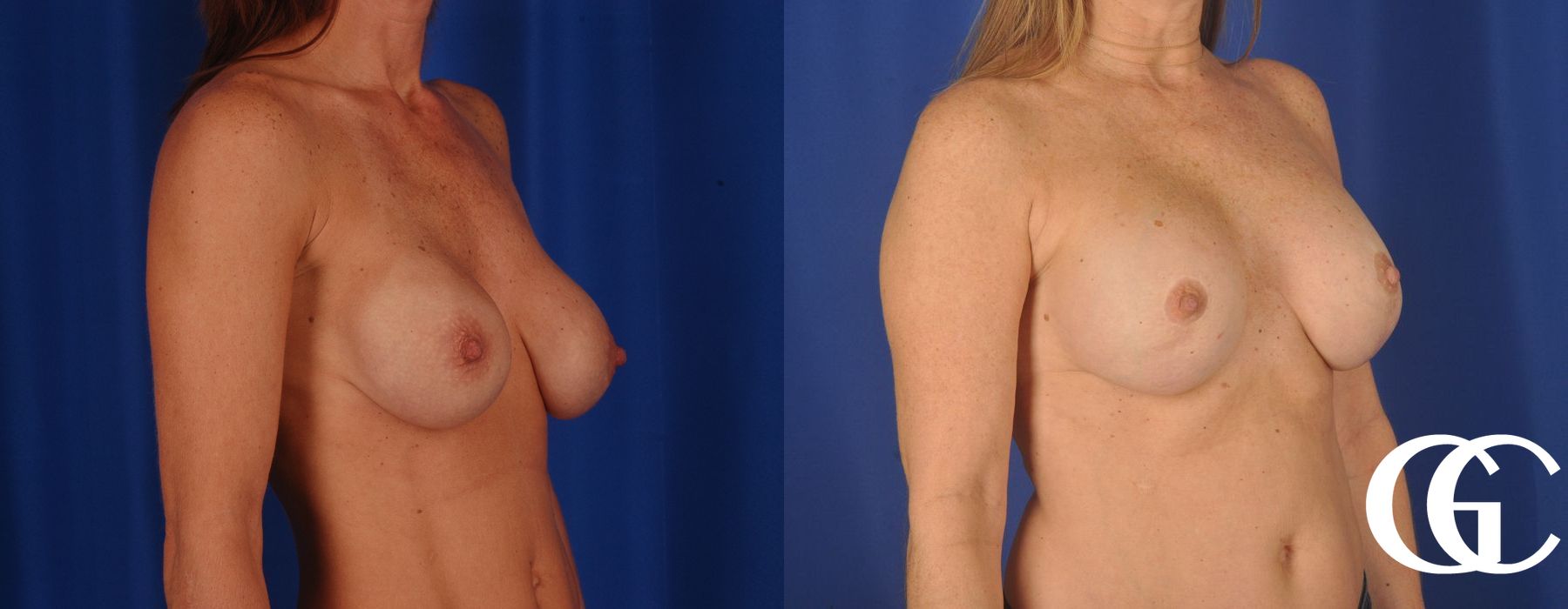 Breast Augmentation - Thumbnail 3