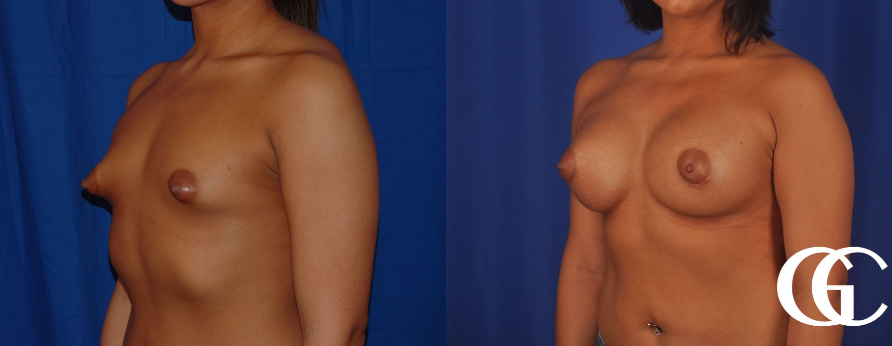 Breast Augmentation - Thumbnail 3