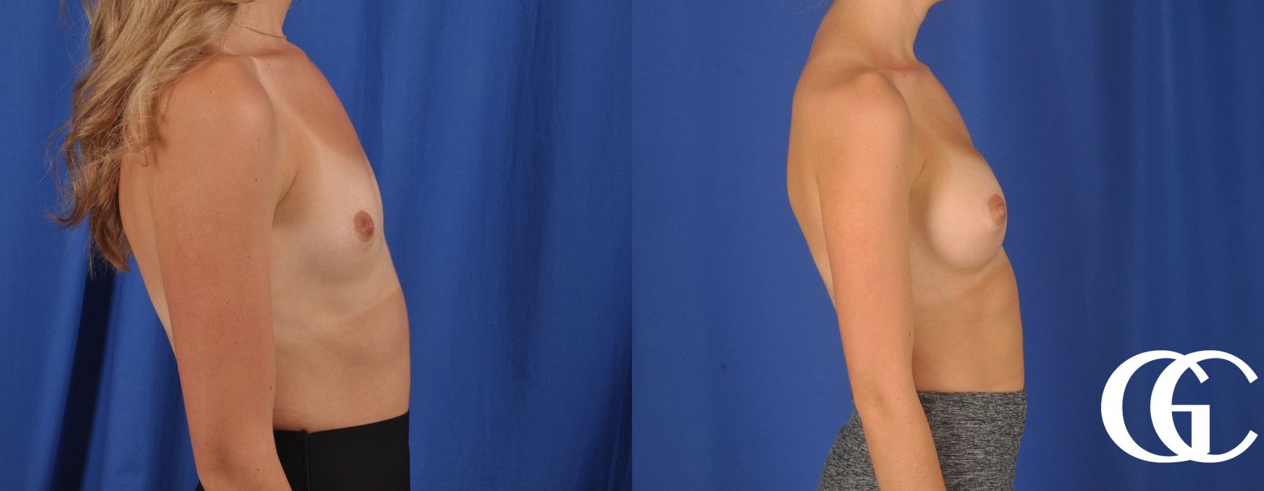 Breast Augmentation - Thumbnail 3