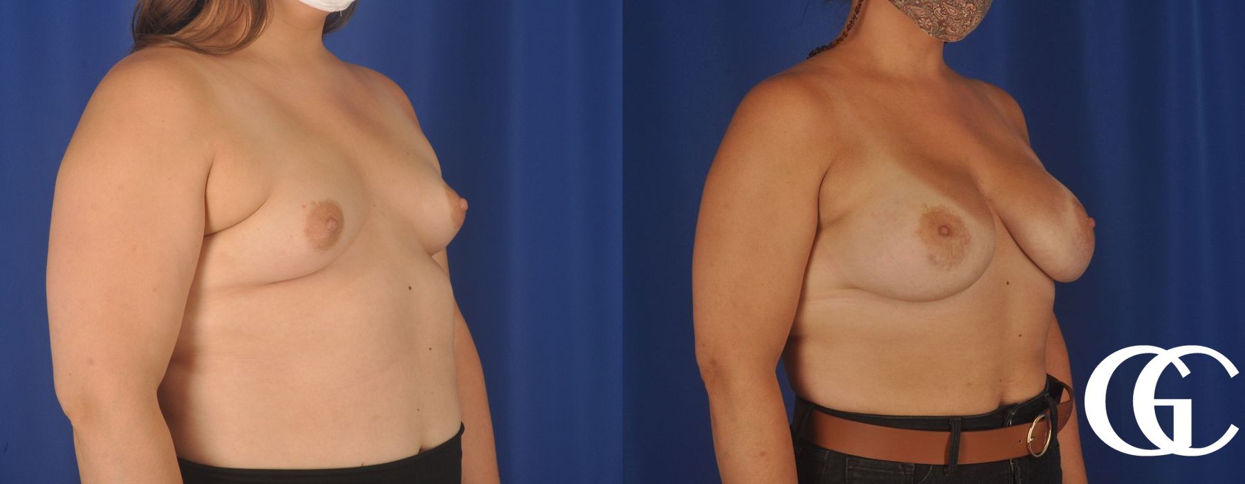 Breast Augmentation - Thumbnail 4