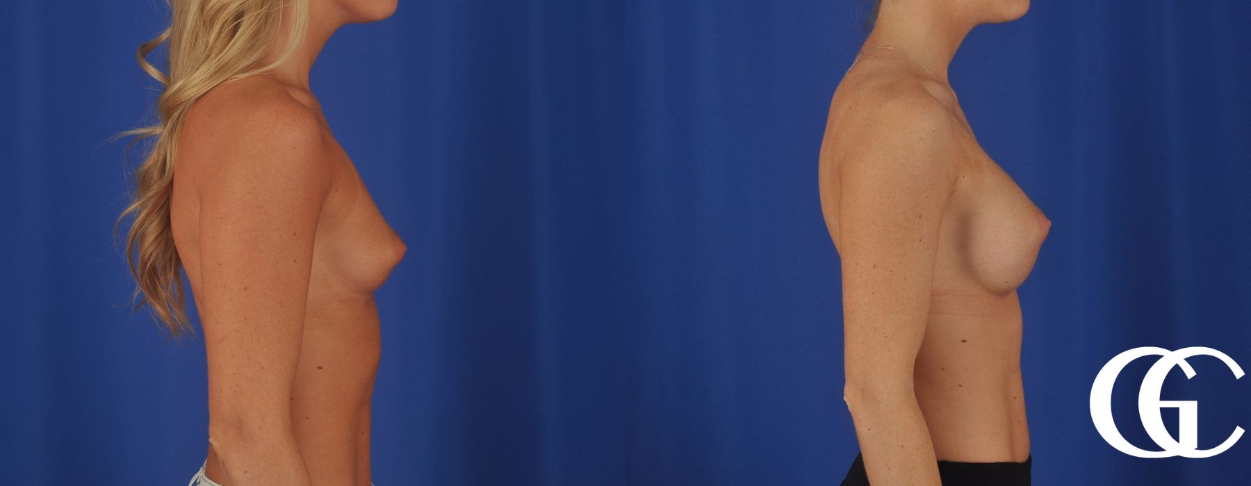 Breast Augmentation - Thumbnail 3