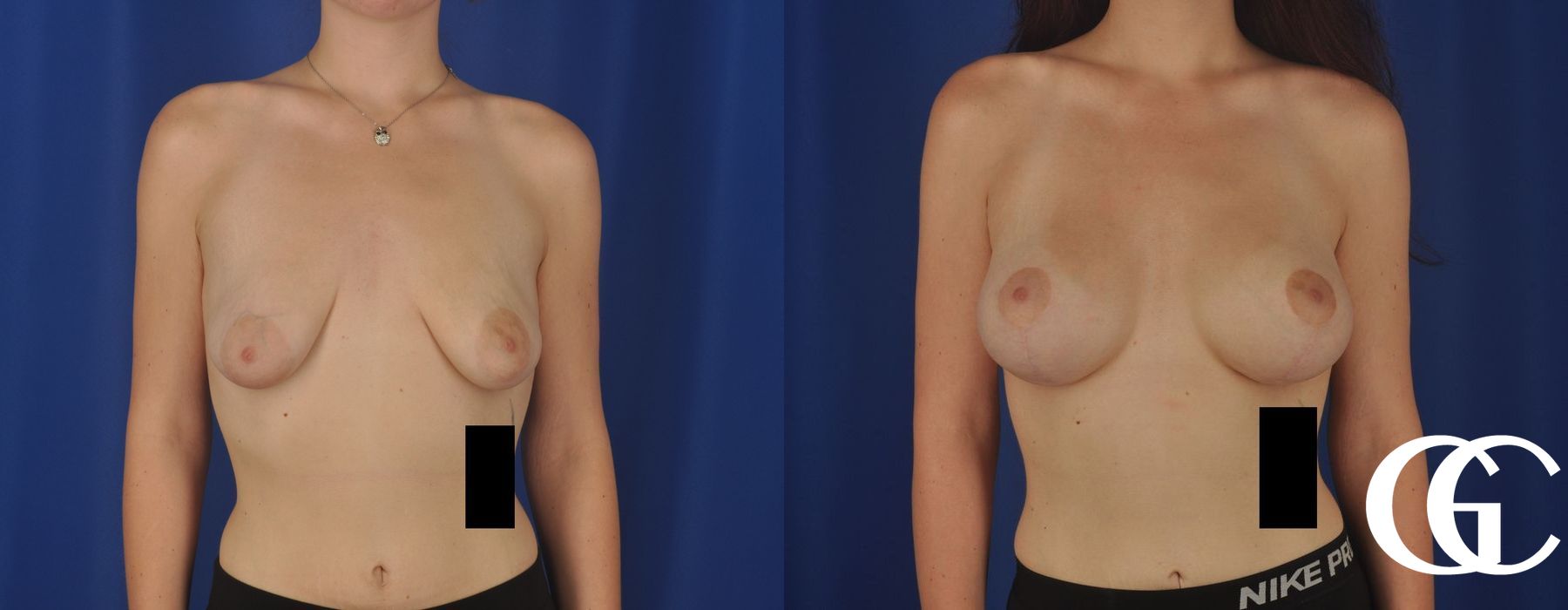 Breast Augmentation - Case 7143