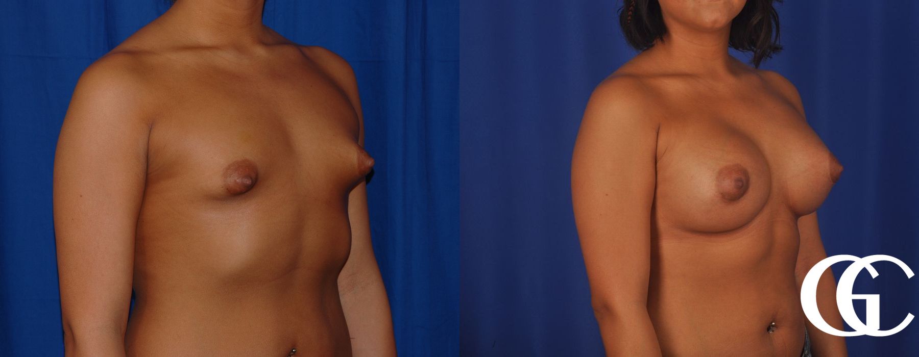 Breast Augmentation - Thumbnail 4
