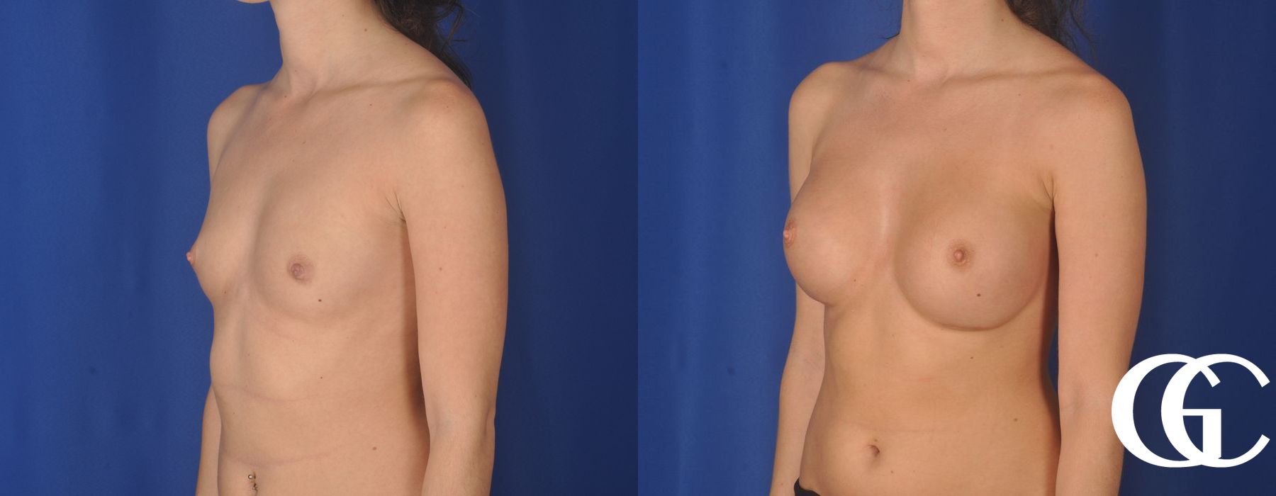 Breast Augmentation - Case 7161