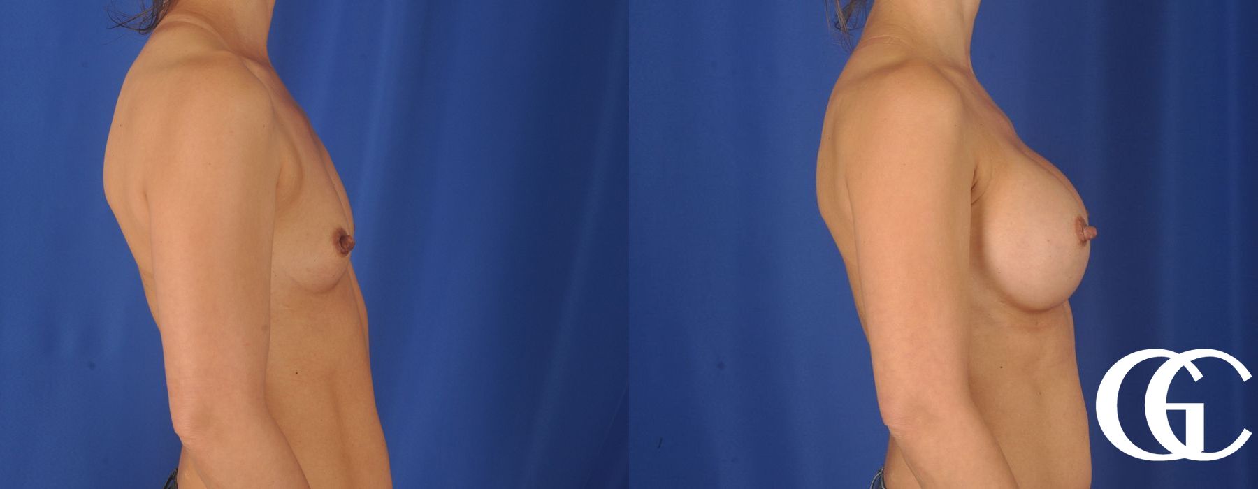 Breast Augmentation - Case 7114