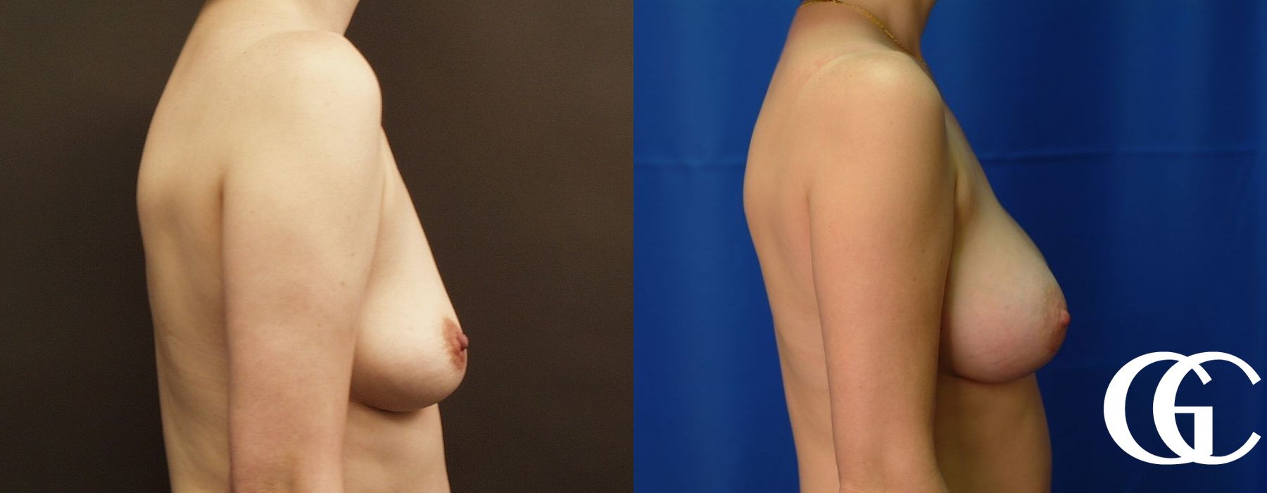 Breast Augmentation - Thumbnail 3