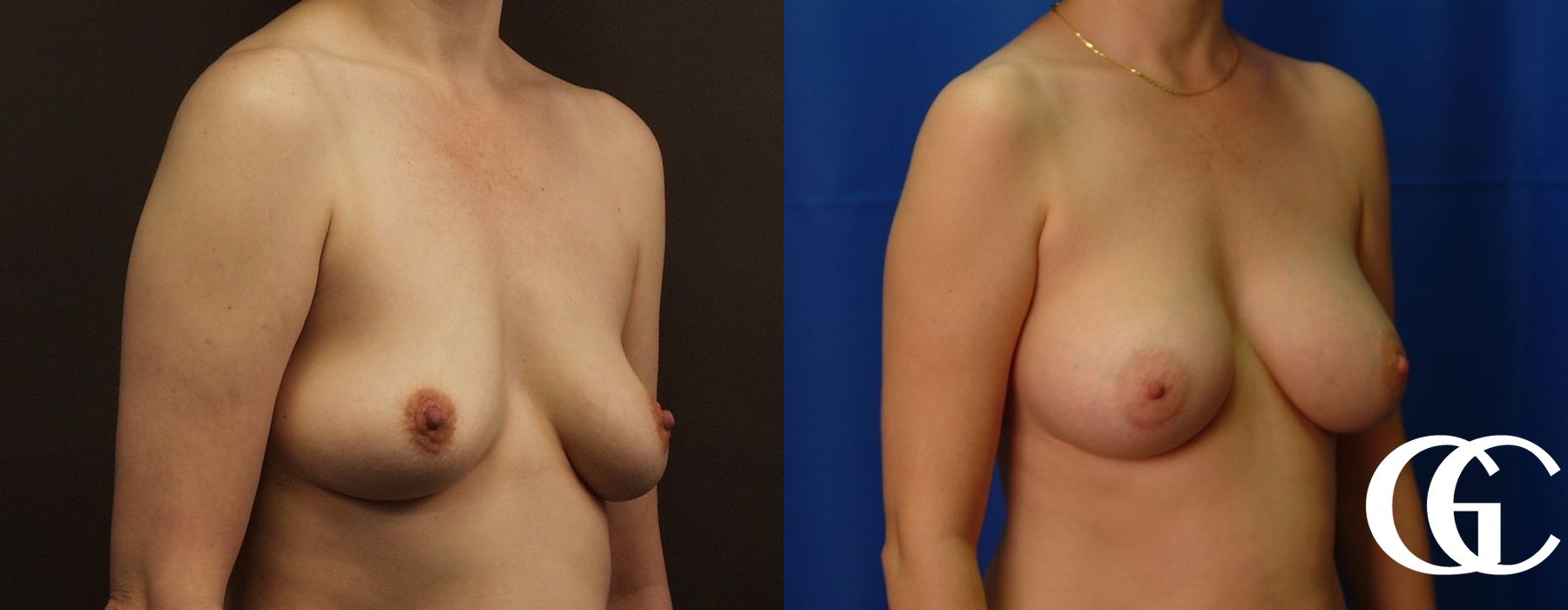 Breast Augmentation - Thumbnail 4