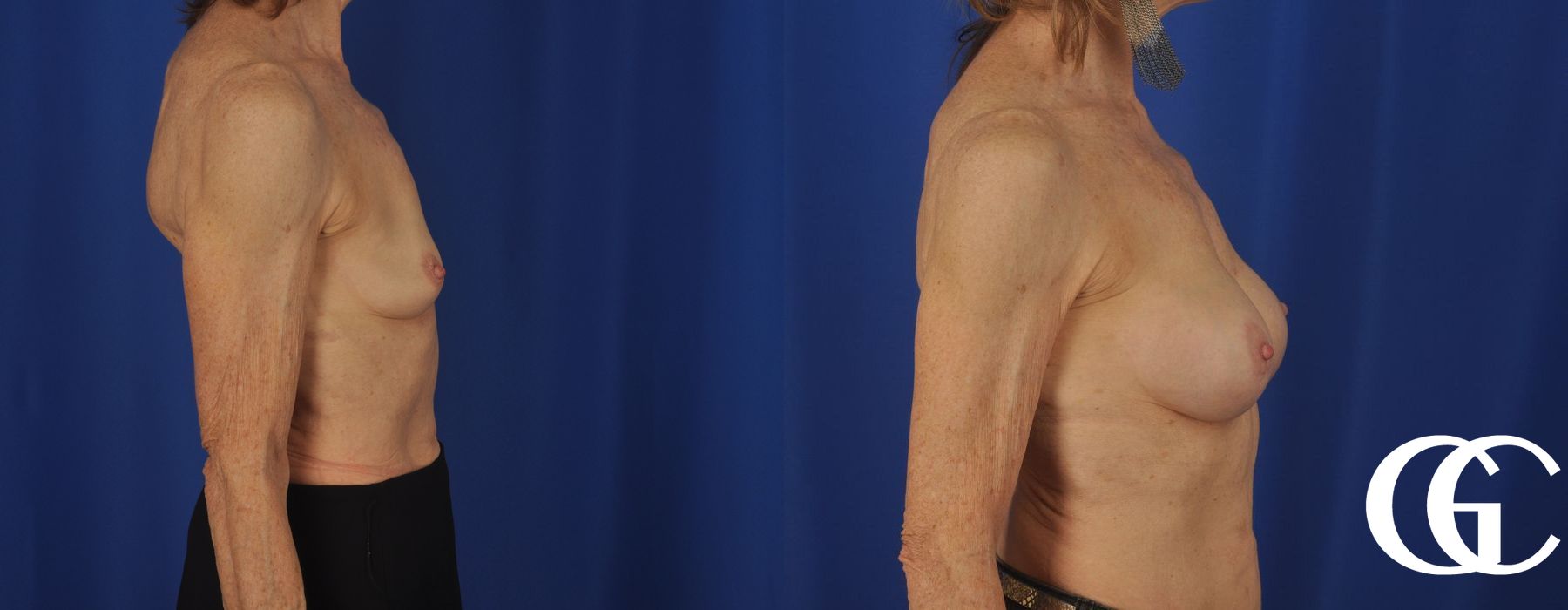 Breast Augmentation - Thumbnail 3