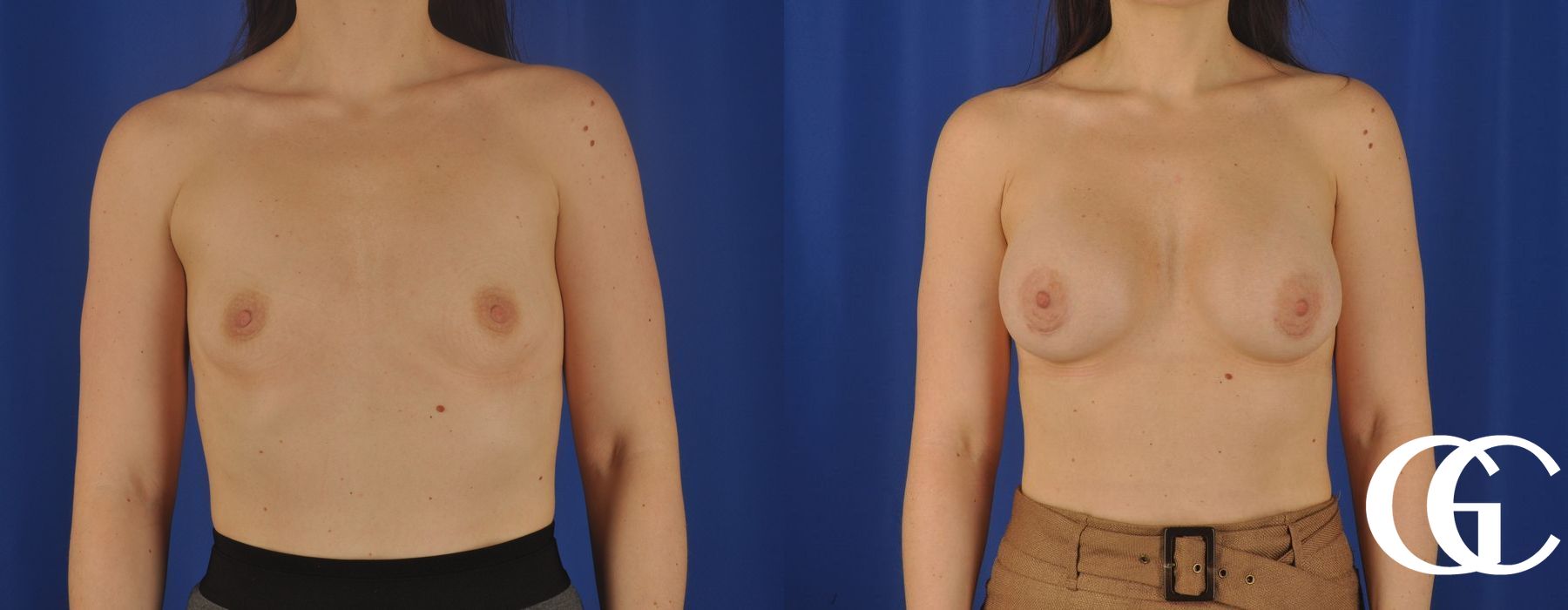 Breast Augmentation - Case 7158