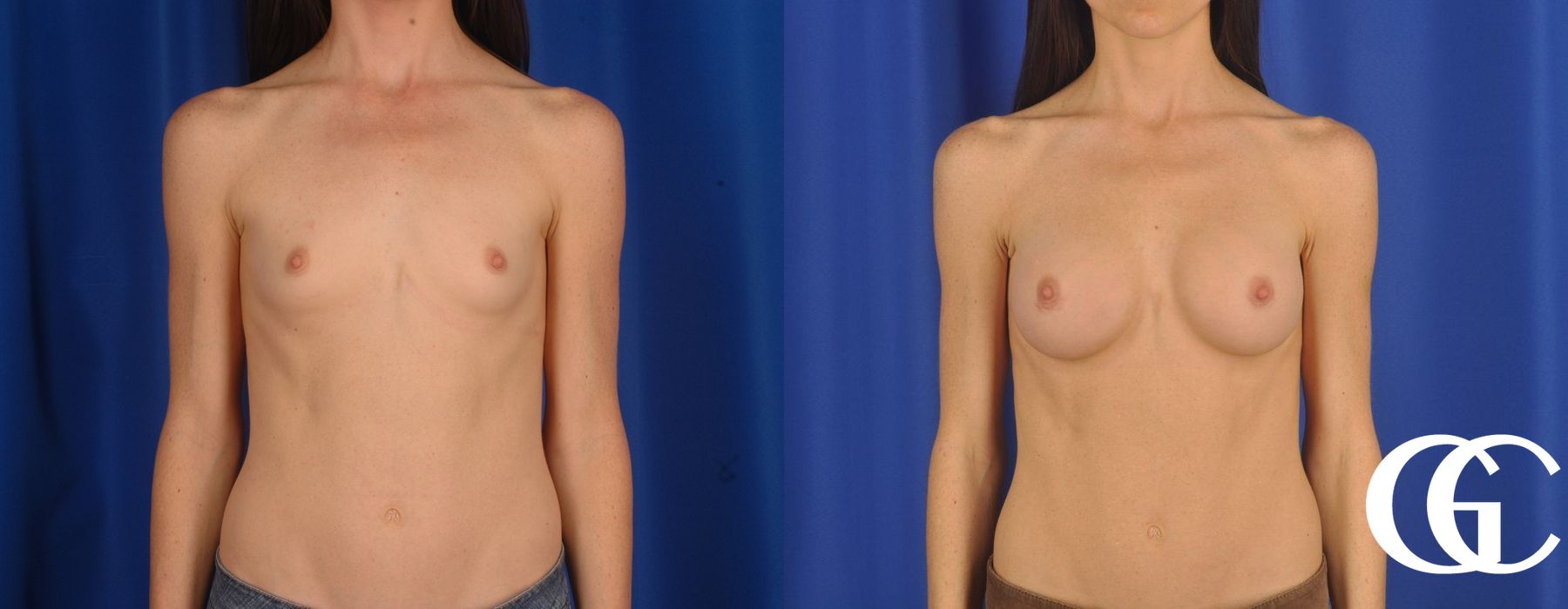 Breast Augmentation - Thumbnail 2