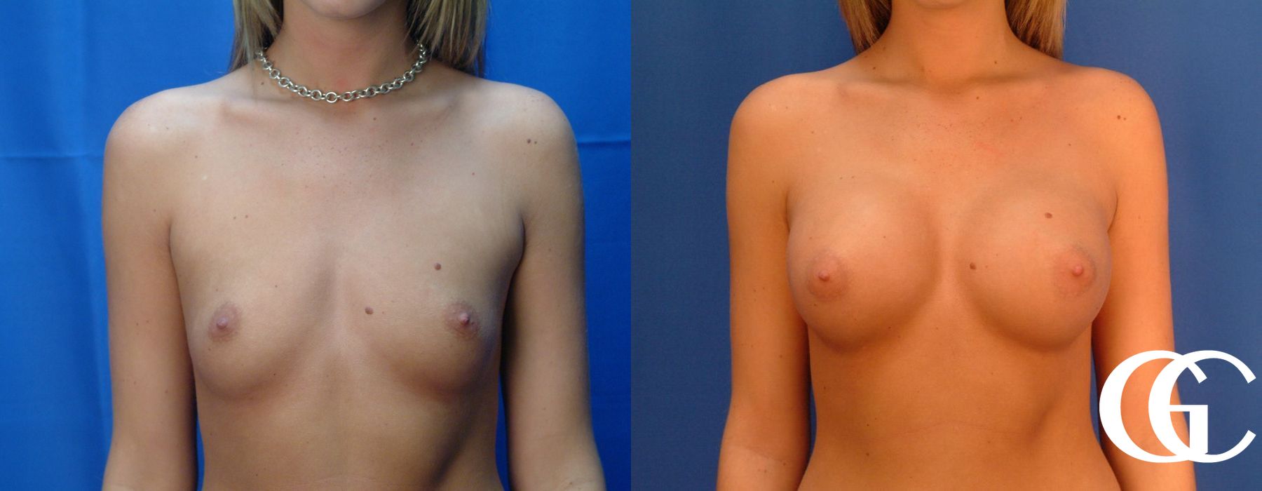 Breast Augmentation - Case 7083