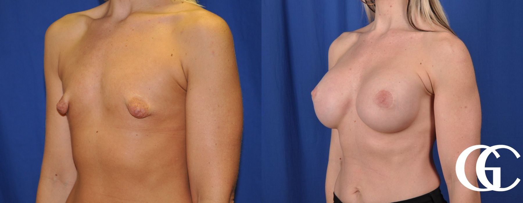 Breast Augmentation - Thumbnail 2