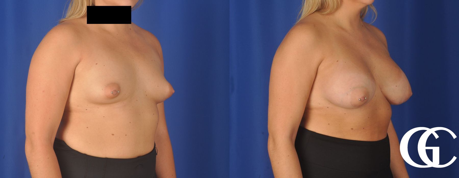 Breast Augmentation - Thumbnail 3
