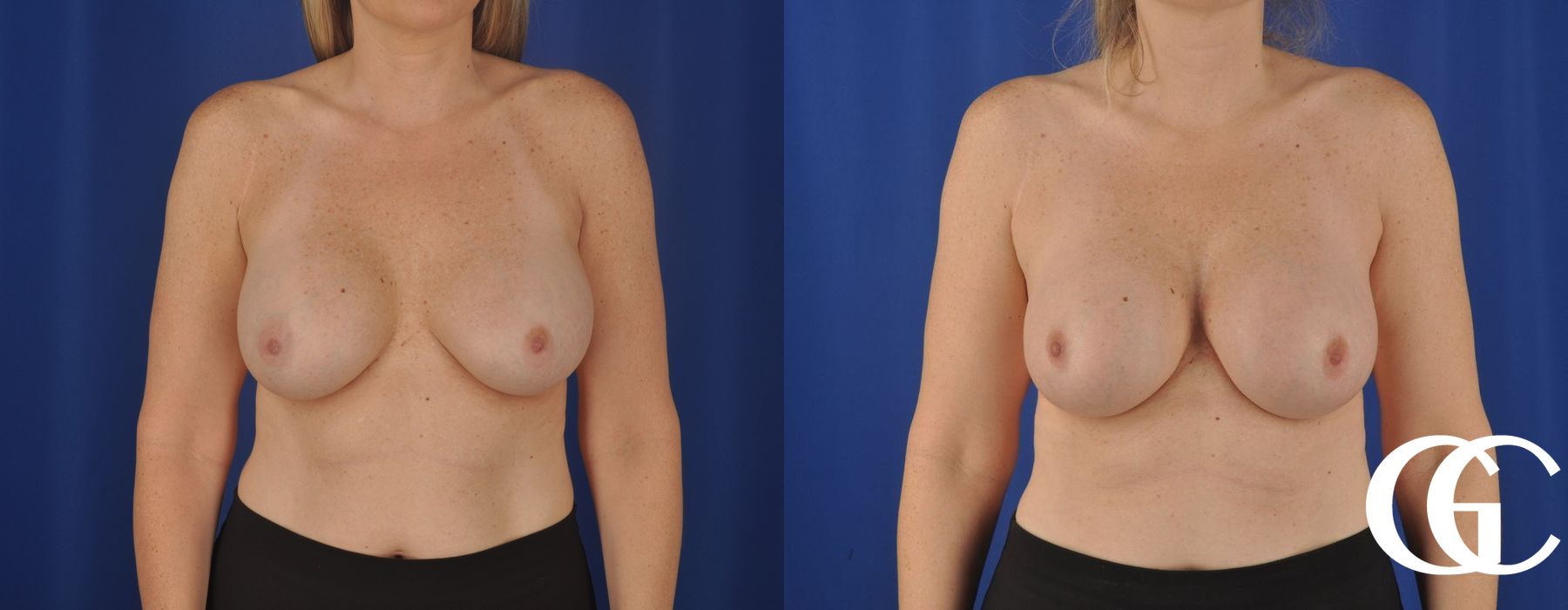 Breast Augmentation - Thumbnail 2