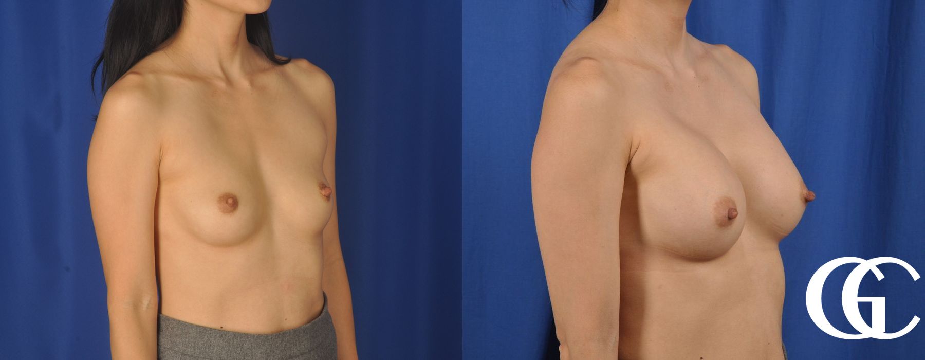 Breast Augmentation - Thumbnail 3