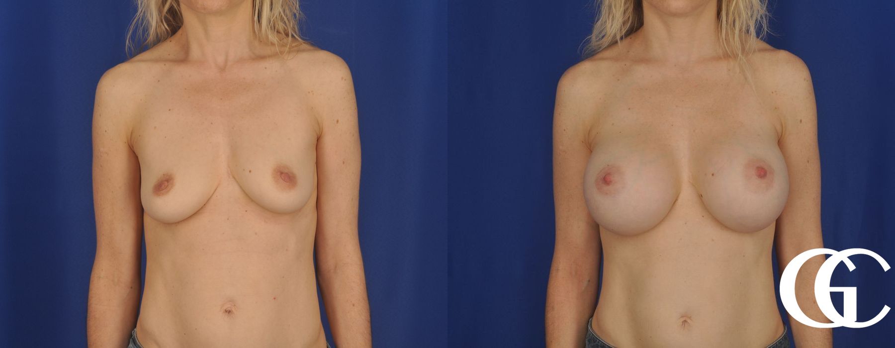 Breast Augmentation - Case 7054