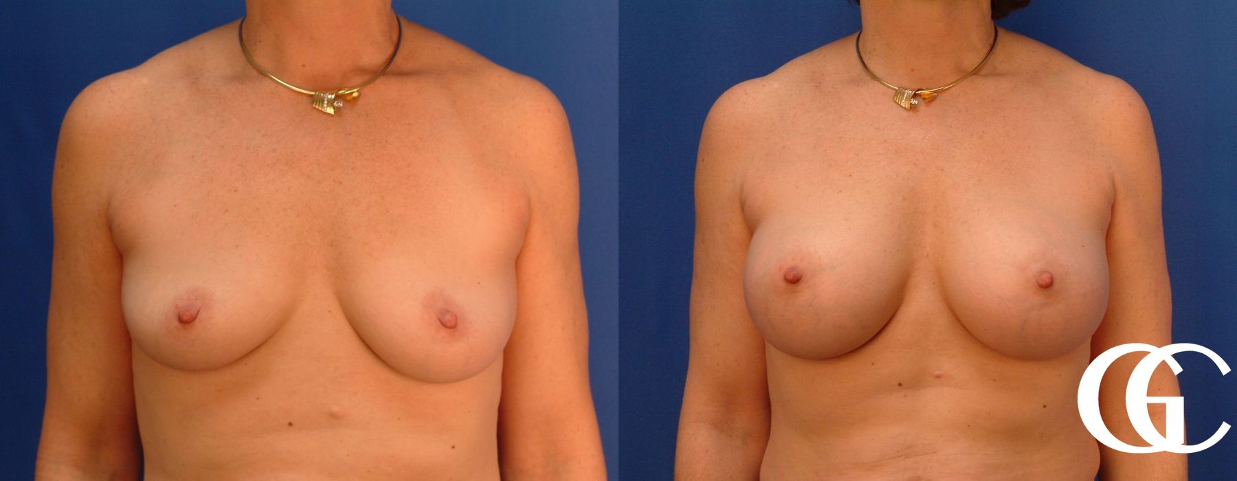 Breast Augmentation - Thumbnail 2