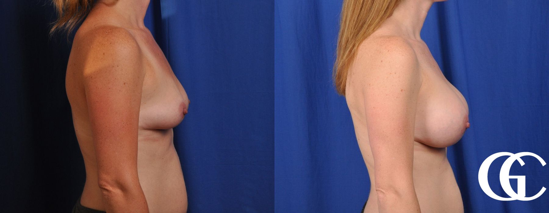 Breast Augmentation - Thumbnail 3