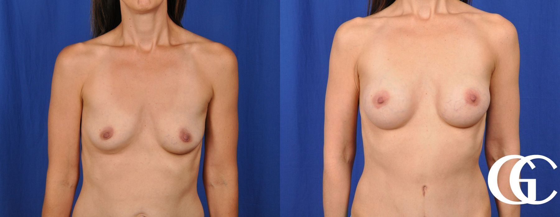 Breast Augmentation - Case 7067