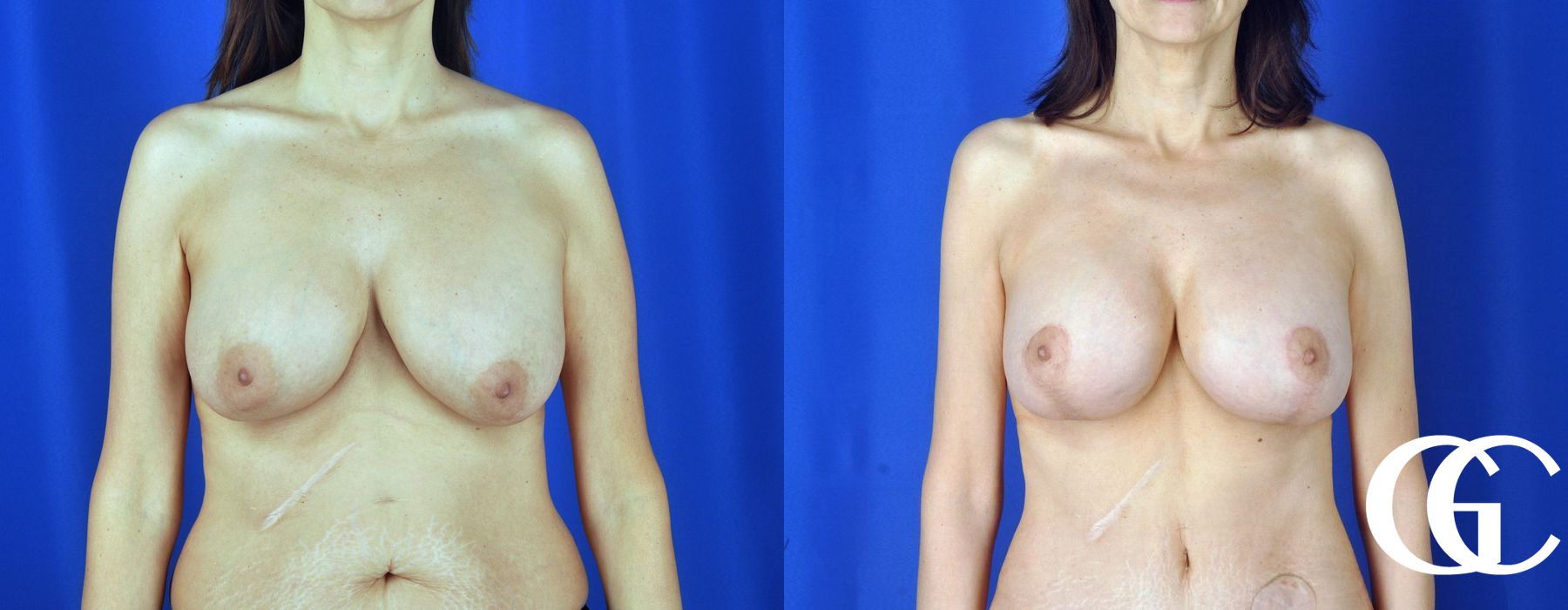 Breast Augmentation - Thumbnail 2