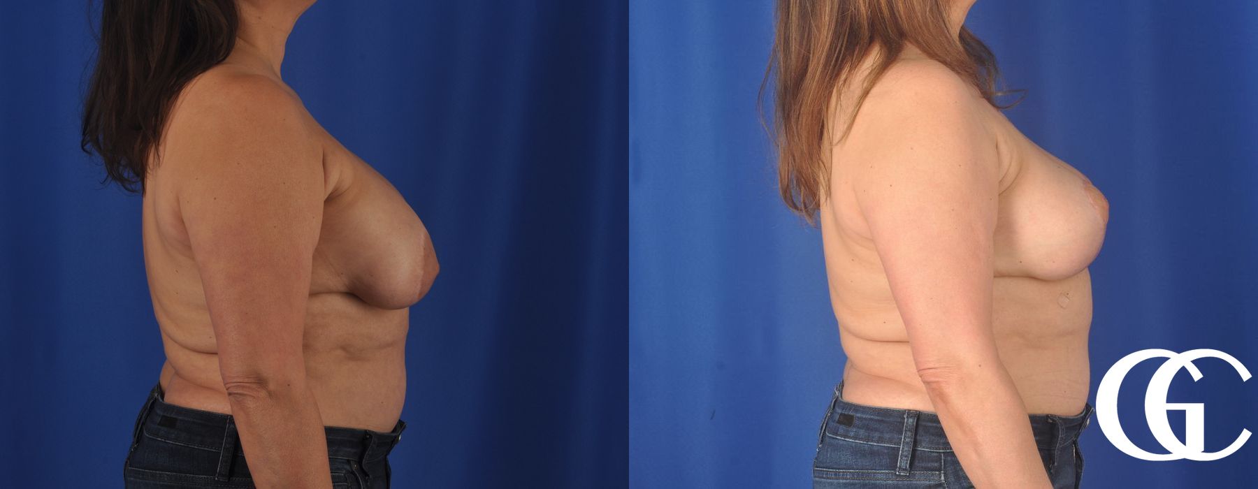 Breast Augmentation - Thumbnail 4