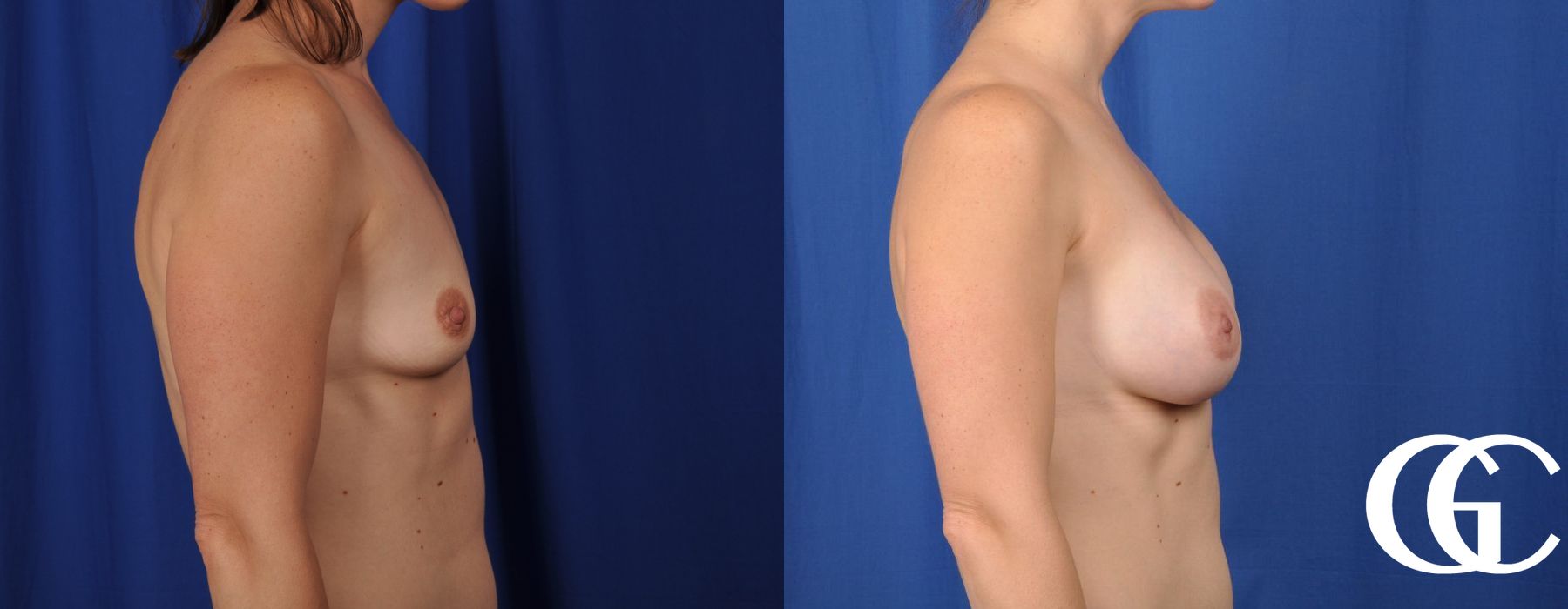 Breast Augmentation - Thumbnail 3