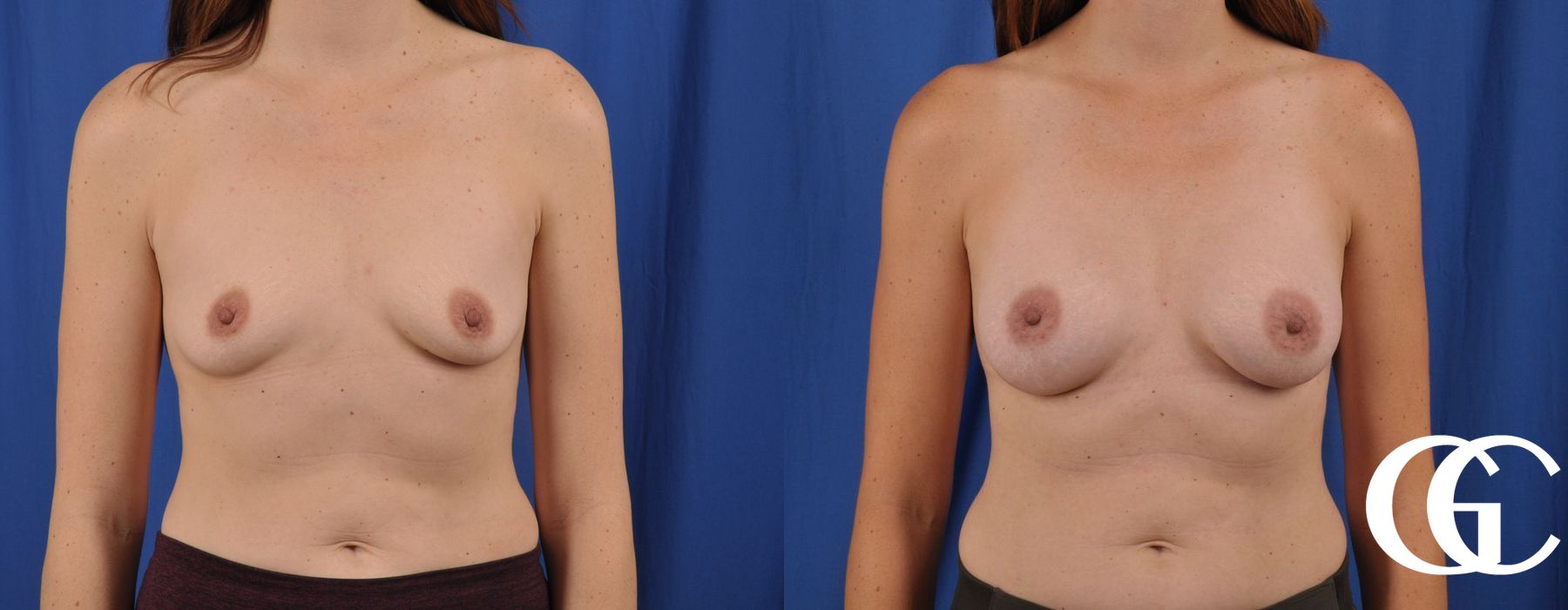 Breast Augmentation - Thumbnail 2