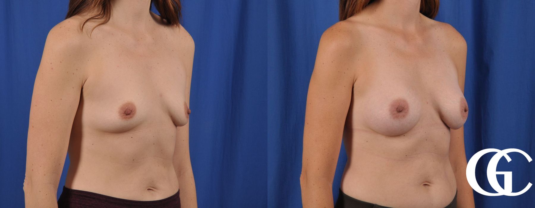 Breast Augmentation - Thumbnail 4